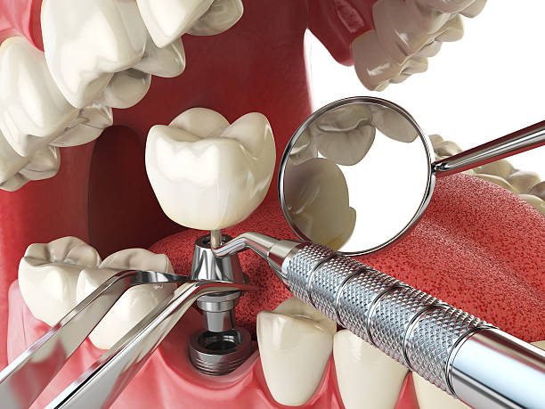 Best Emergency Root Canal Treatment in Benton, TN